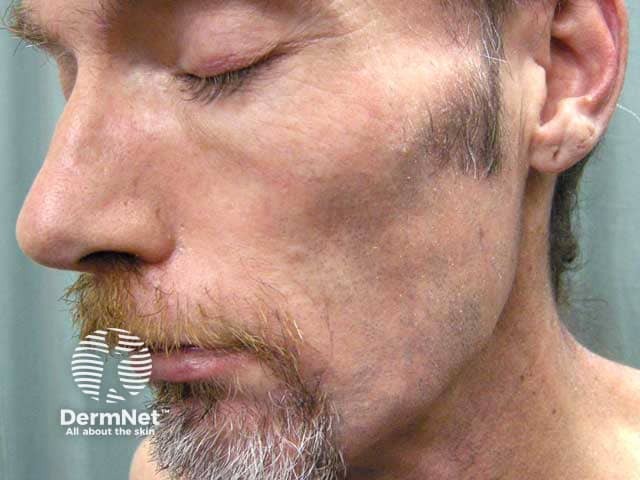 Facial lipodystrophy in HIV