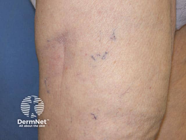 Localised lipoatrophy on the thigh