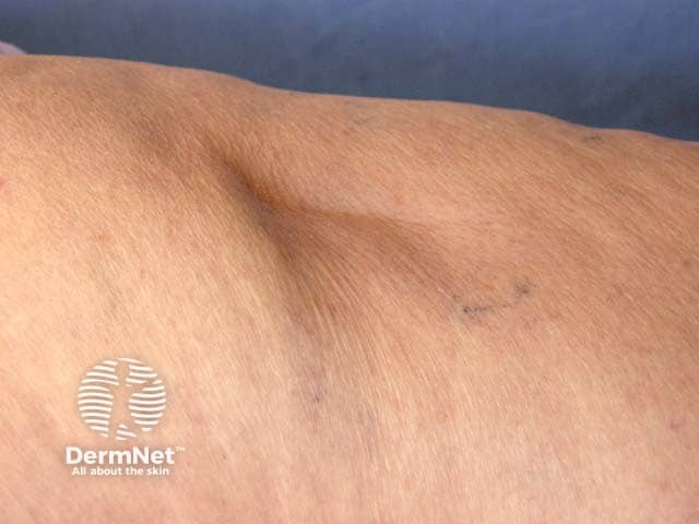 Localised lipoatrophy on the thigh