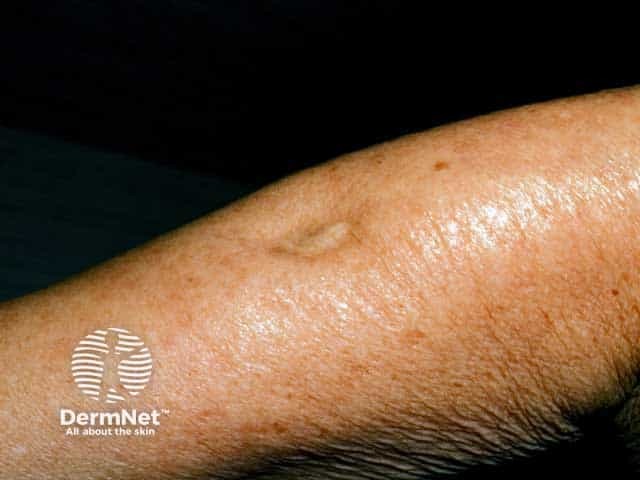 Steroid injection induced lipoatrophy on the arm