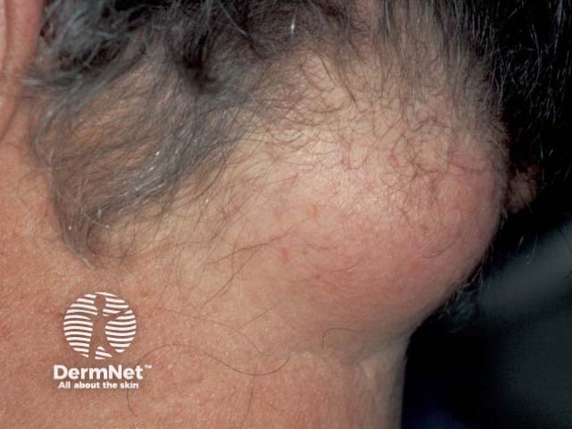 A large lipoma on the nape of the neck stretching the overlying scalp