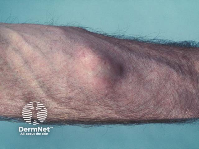 A lipoma on the arm - the lobular nature is visible; often it can only be appreciated on palpation