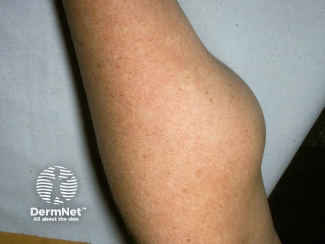 A large disfiguring lipoma on the arm