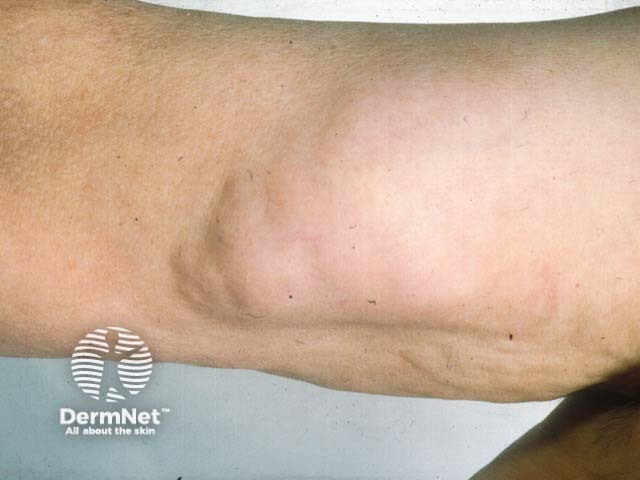 A large lipoma on the upper arm