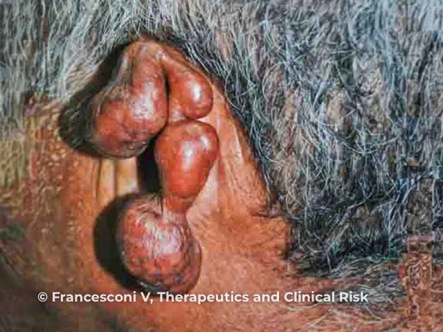 Auricular destruction due to lobomycosis