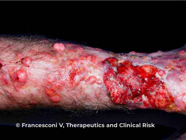 Nodules and ulcers due to lobomycosis on the leg