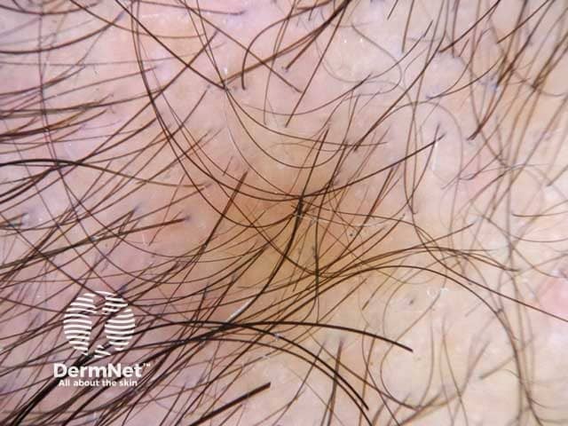 Dermoscopic image of androgenetic alopecia in a male patient showing hair shaft diversity of more than 20%.