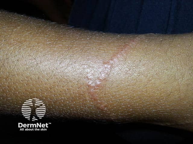 Early serpiginous lesions showing swelling and scale after box jellyfish stings on the arm