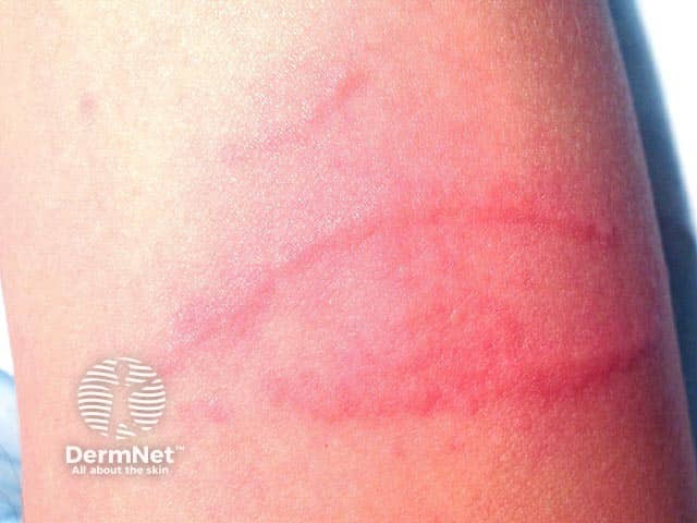 Early urticated swellings from jellyfish stings 