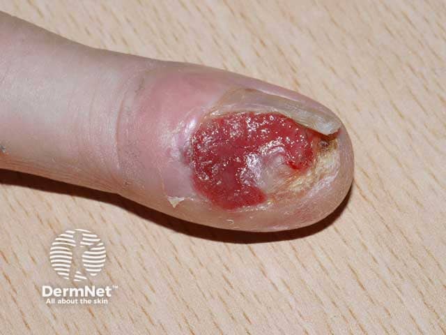 Melanoma of the nail unit