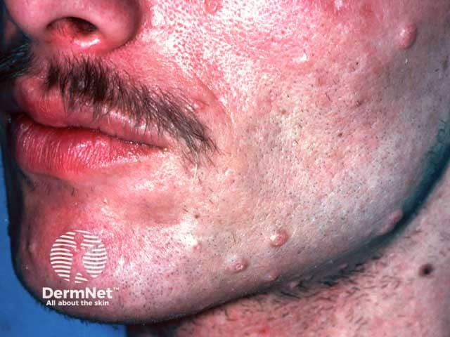 Extensive molluscum contagiosum in HIV