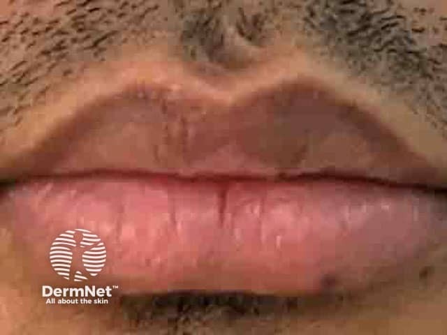 Resolved lip lesion on day 14 of monkeypox infection