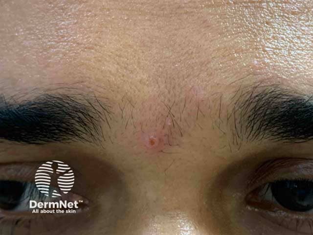 Early lesion of monkey pox on the glabella