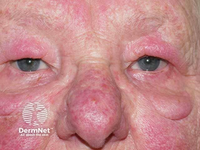 Violaceous swelling of the upper and lower lids with nasal rosacea in Morbihan disease