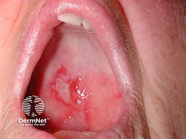 Palatal erosions due to mucous membrane pemphigoid