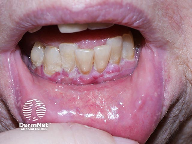 Desquamative gingivitis due to mucous membrane pemphigoid