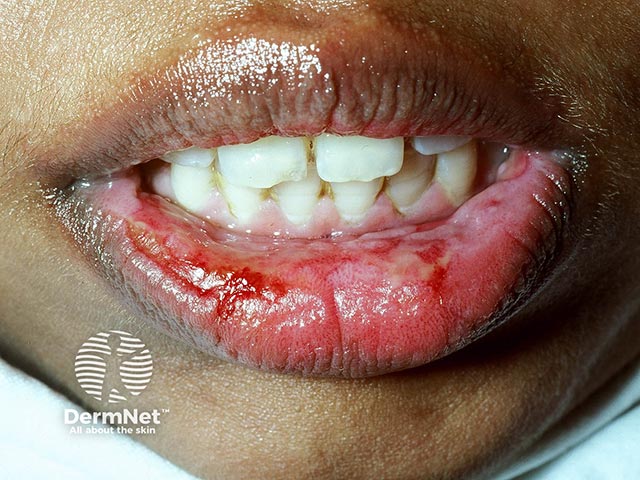 Erosions on the lip and buccal mucosa due to mucous membrane pemphigoid