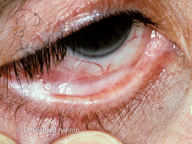 Early symblepharon due to mucous membrane pemphigoid