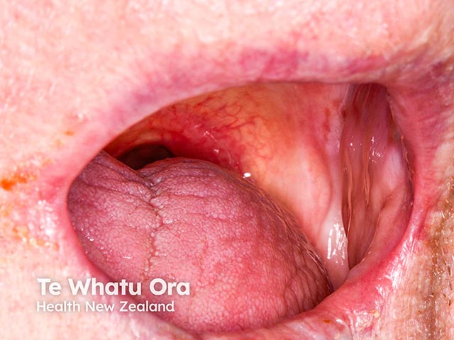 Scarring and telangiectasia on the palate due to mucous membrane pemphigoid