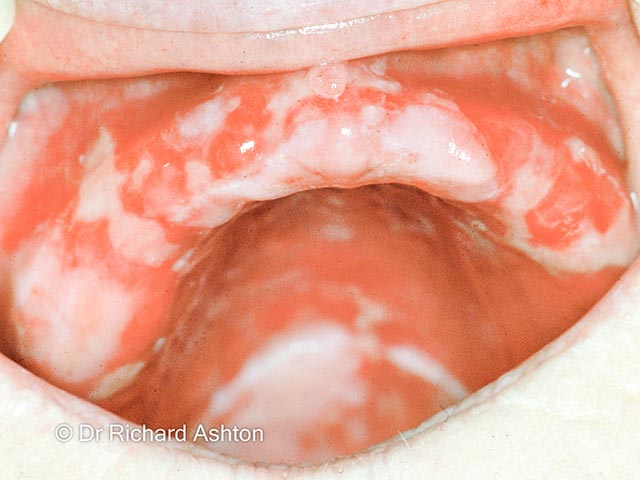 Ulceration, scarring and loss of dentition due to mucous membrane pemphigoid