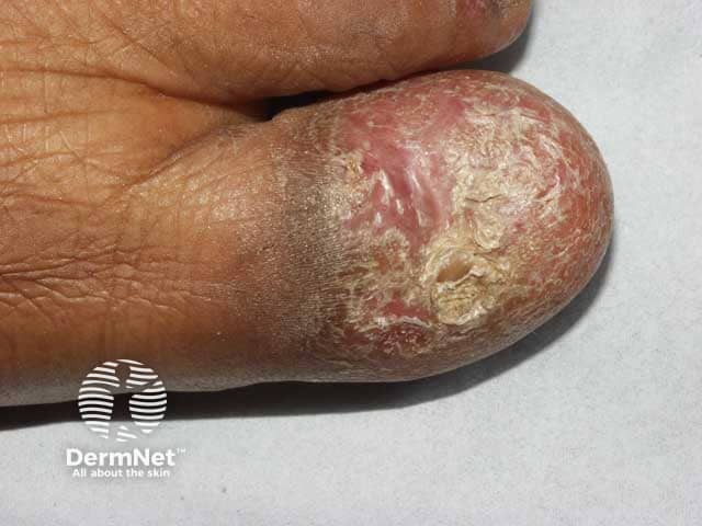 Complete nail plate destruction due to lichen planus