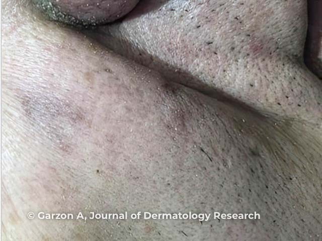 Neutrophilic sebaceous adenitis - a gratifying response to oral dapsone