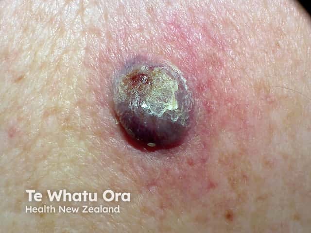 An ulcerated and crusted purple-red rapidly growing lesion on the back - histology showed a nodular melanoma