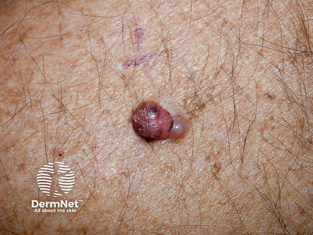 A nodular lesion with a medial satelllite lesion - the larger part is pink with dark brown and black speckles suggesting an amelanotic nodular malignant melanoma