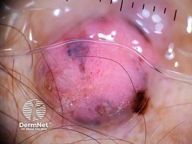 Dermoscopy shows a pink lesion with atypical vessels and speckles of pigment peripherally - it was an 8.3 mm Breslow thickness malignant melanoma