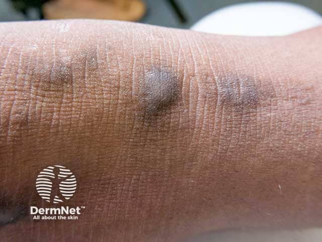 Pigmentation of prurigo nodules in skin of colour