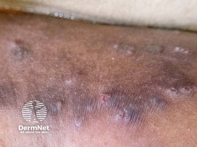 Pigmentation in nodular prurigo on the leg