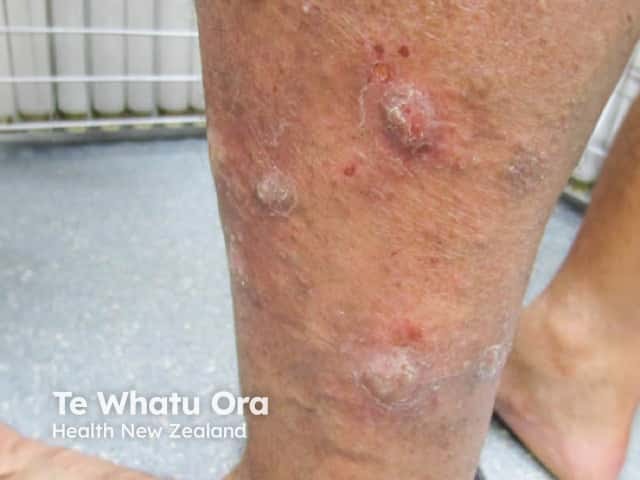 Large lesions of nodular prurigo on the calf