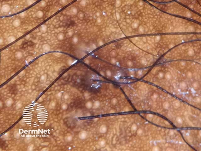 Dermosocpic image of a honey comb pattern in a female of African ethnicity