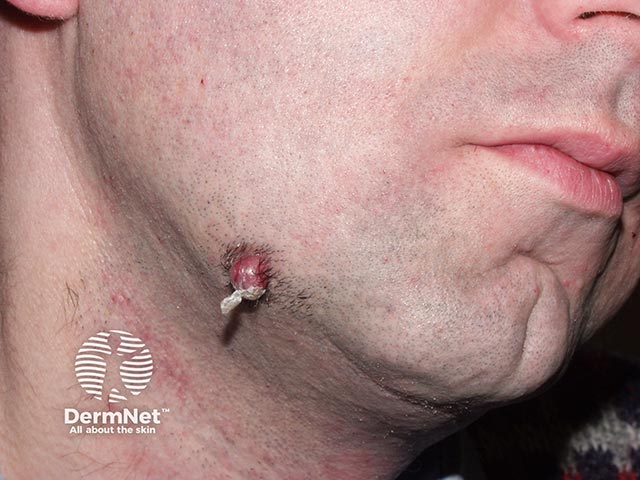 A granuloma at the end of a dental sinus