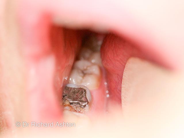 A carious tooth that is the cause of a dental sinus