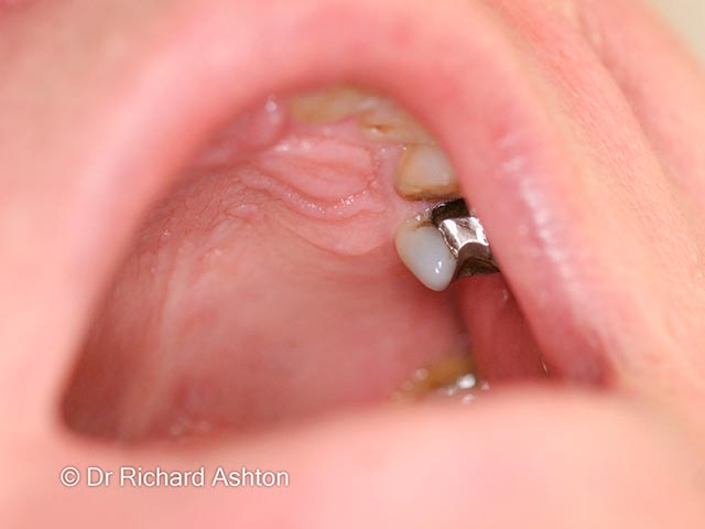 The source of dental infection resulting in a maxillary dental sinus