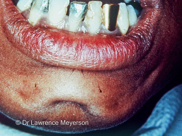 Indentation and tethering of a chin dental sinus