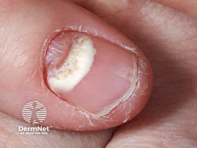 Proximal onychomycosis