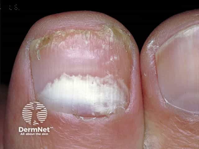 Proximal onychomycosis