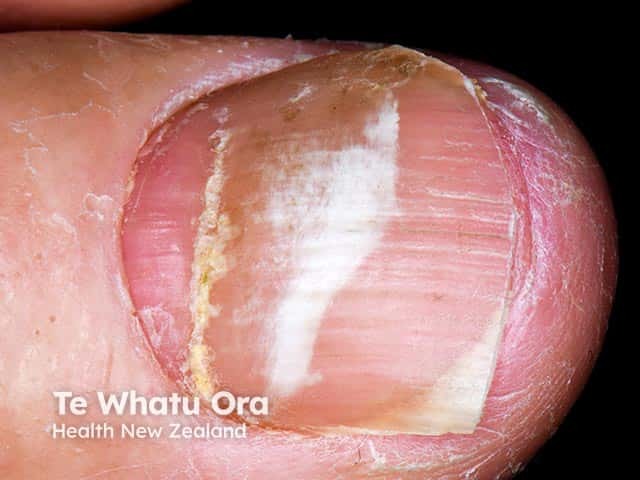 Proximal onychomycosis