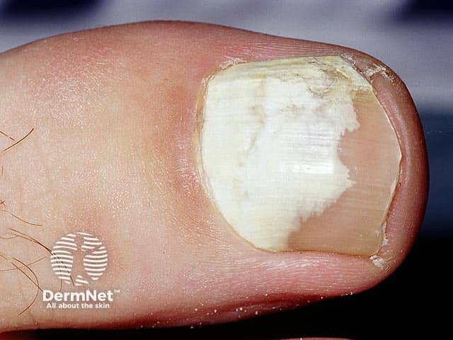 Proximal onychomycosis