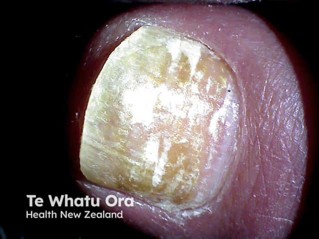 Superficial white onychomycosis