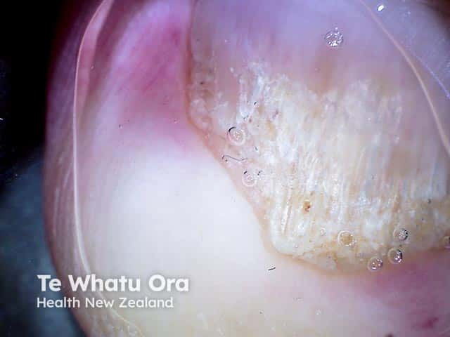 Dermoscopy of distal and lateral onychomycosis