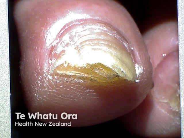 Lateral onychomycosis of a toe nail