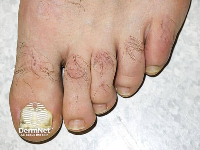 Total onychomycosis due to Fusarium species