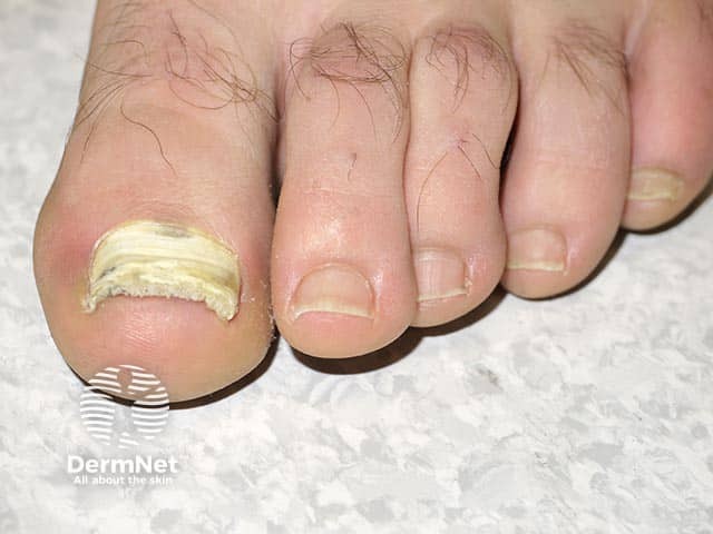 Total onychomycosis due to Fusarium species