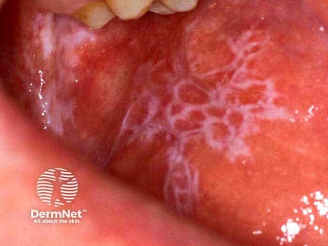 Reticulate buccal mucosal lichen planus