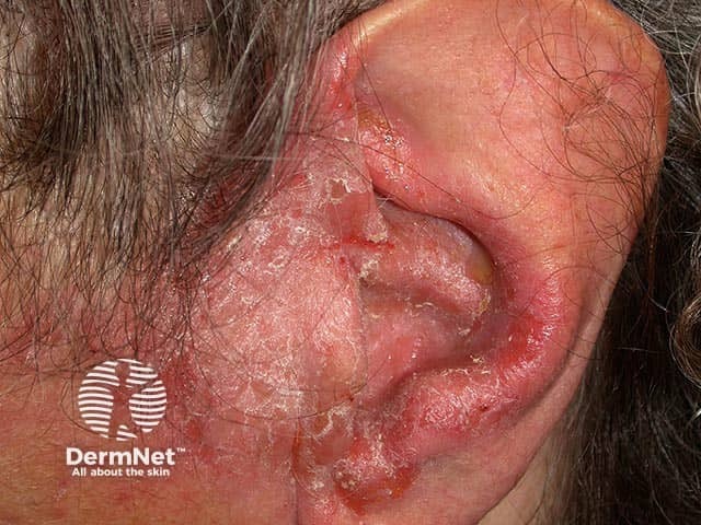 Chronic otitis externa extending onto the preauricular skin