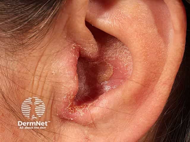 Otitis externa