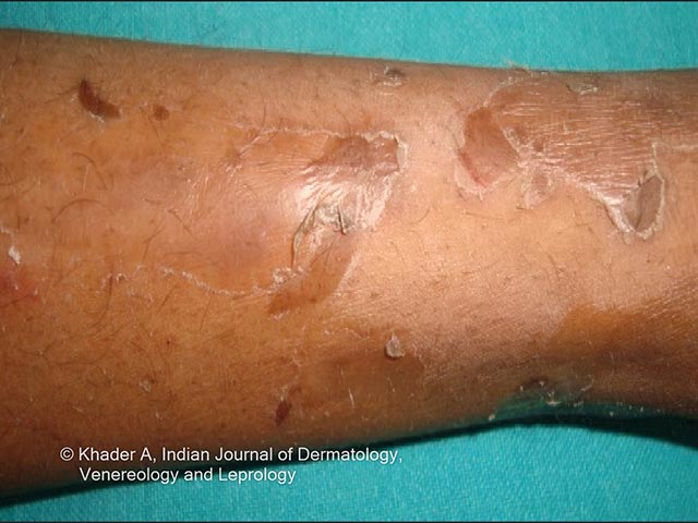 Skin peeling seen in PLACK syndrome